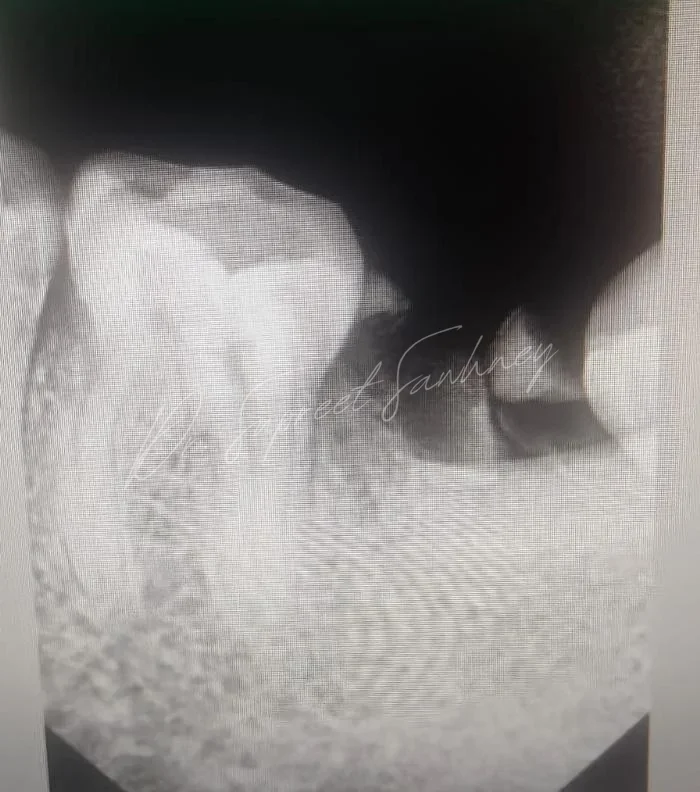 Pre-placement periapical radiograph of a posterior mandibular missing-tooth site
